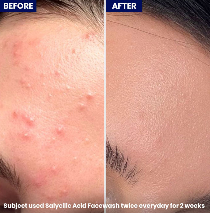 Clarevo Salicylic Acid Facewash