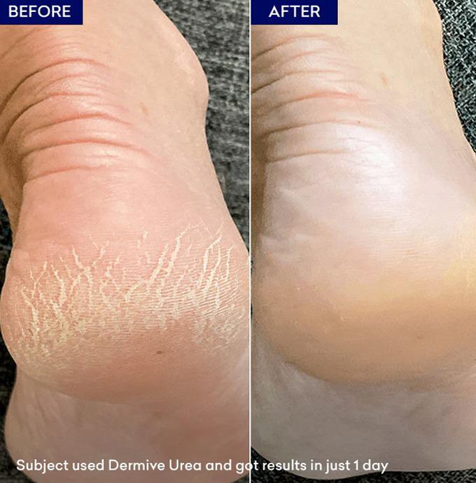 Dermive Urea Economy Pack