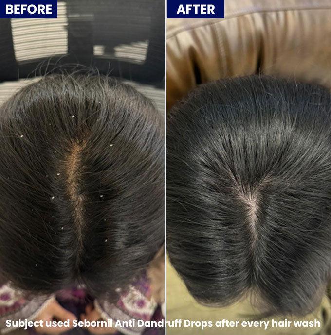 Sebornil Anti Dandruff Drops